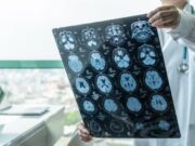 ASTUCE Spain insta el Ministeri de Sanitat a reconèixer l’oligodendroglioma com a malaltia rara
